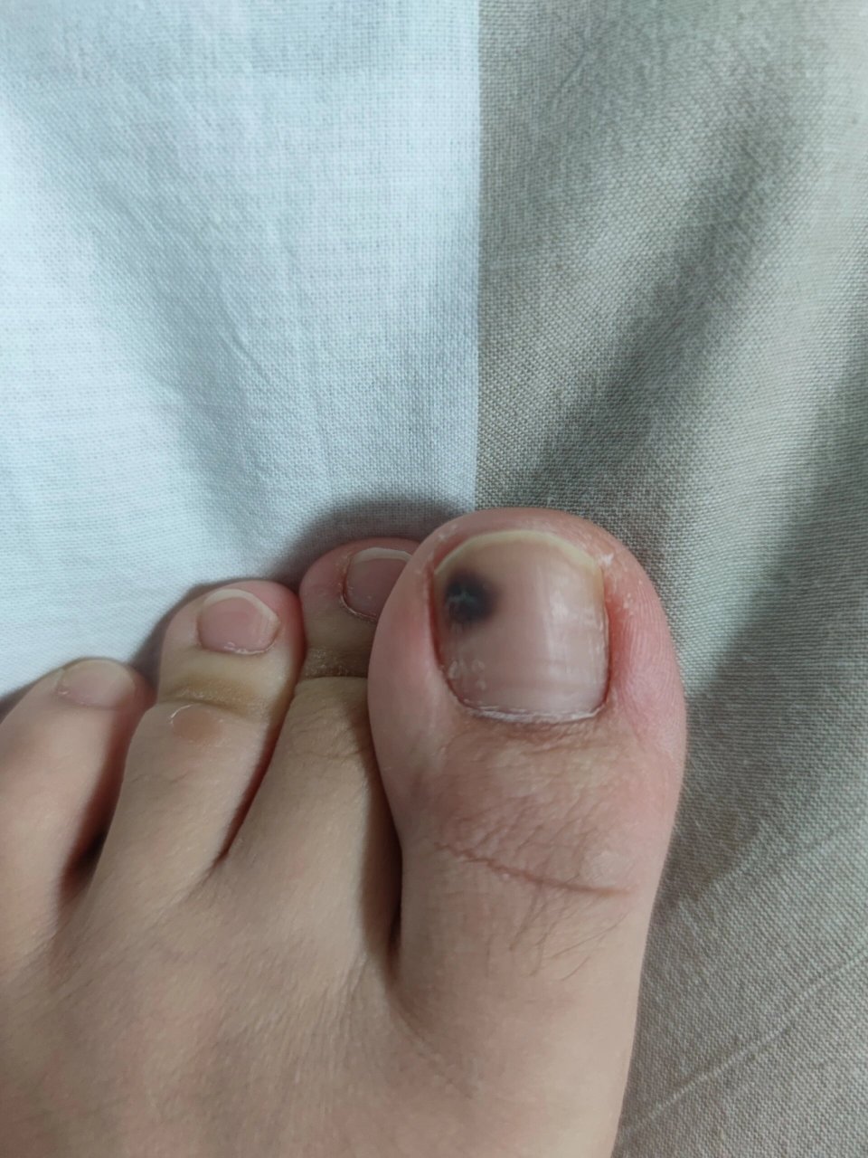 好丑,不敢露脚趾了,哭!