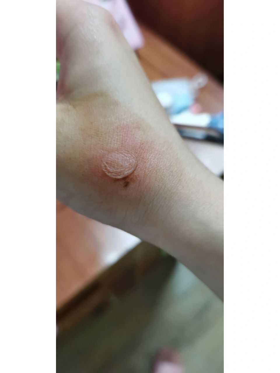烫伤水泡 晚上抱着热水袋睡觉,本来是隔着一层被子抱,睡太香了,不知道