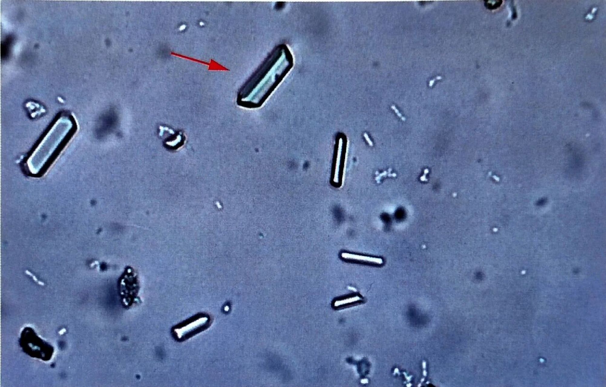 临床检验之《磷酸铵镁结晶》    磷酸铵镁结晶 形态特点:无色透明,呈