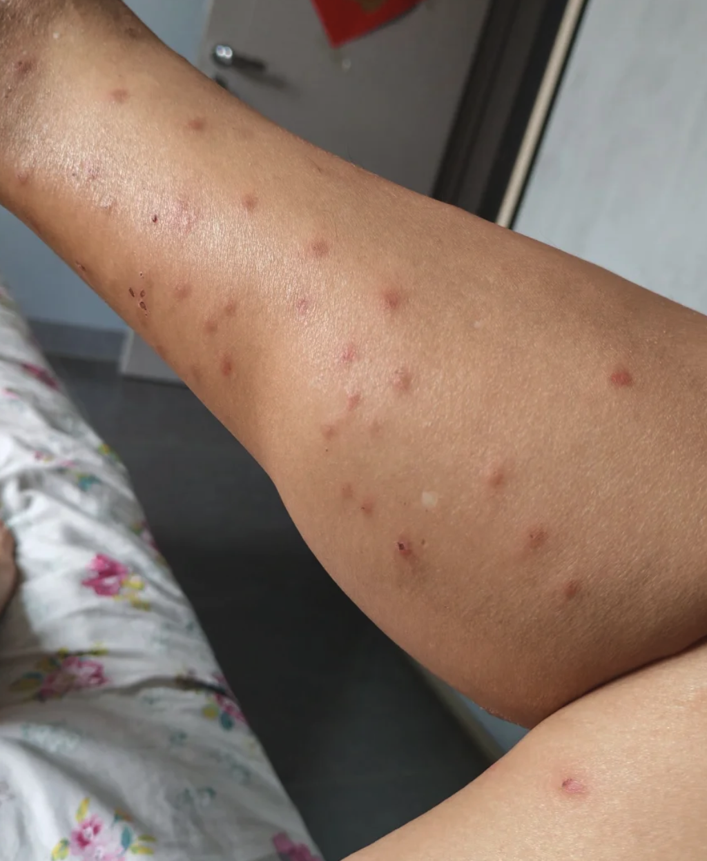 如果是过敏引起的,皮肤被叮咬后会出现红肿,瘙痒