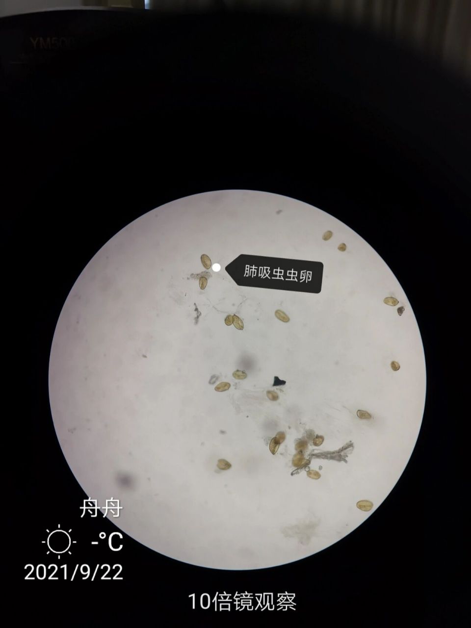寄生虫笔记—吸虫篇2:肺吸虫