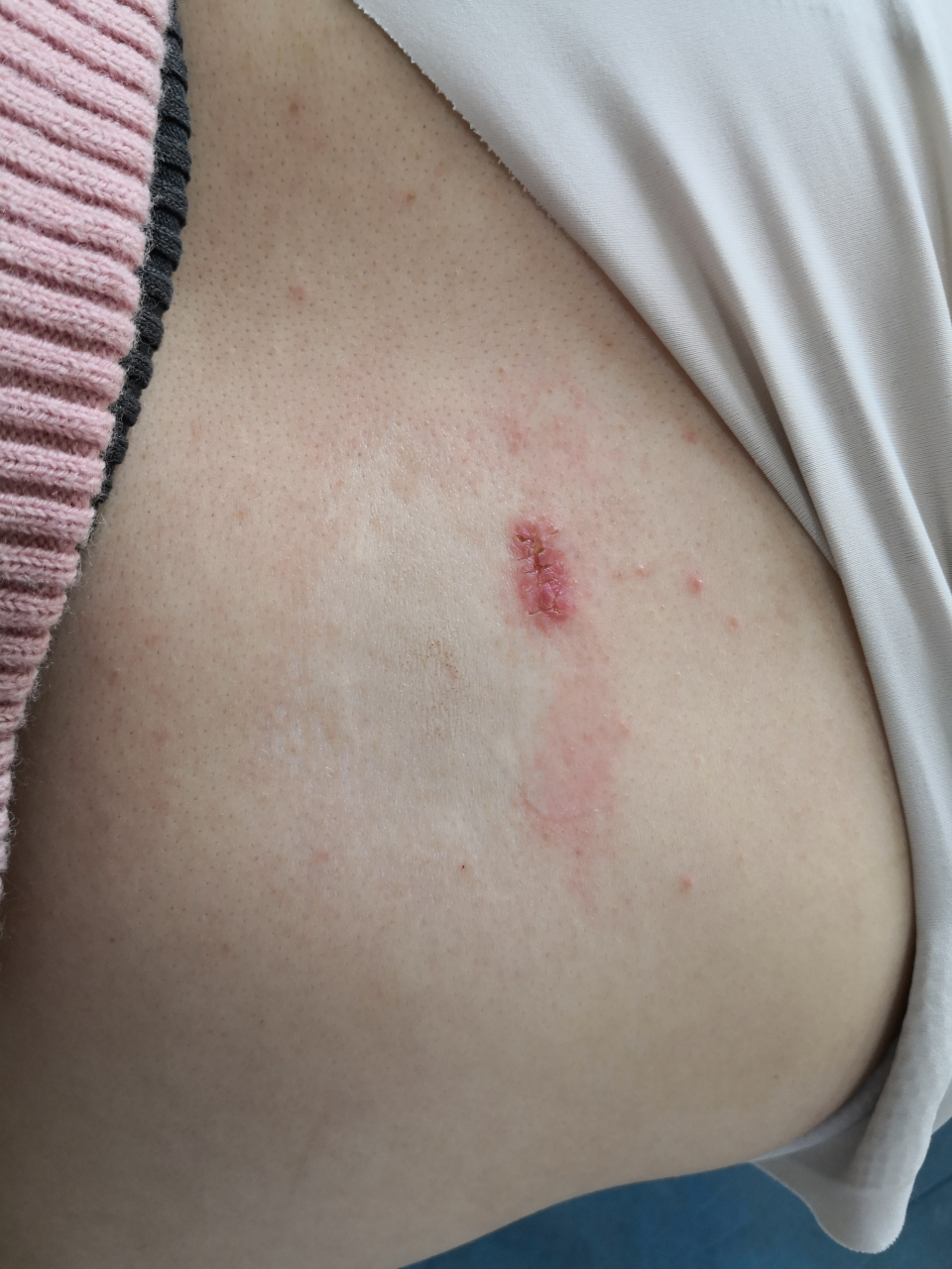 背部色素减退性白斑.#活检##皮炎