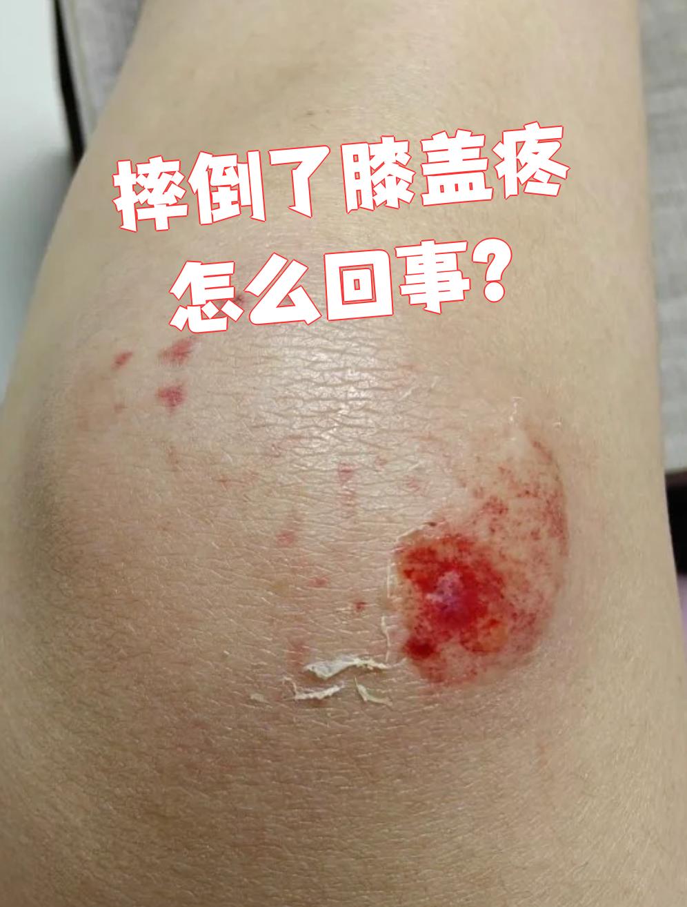 摔倒后膝盖疼,常见原因包括软组织损伤,髌骨骨折和膝交叉韧带损伤