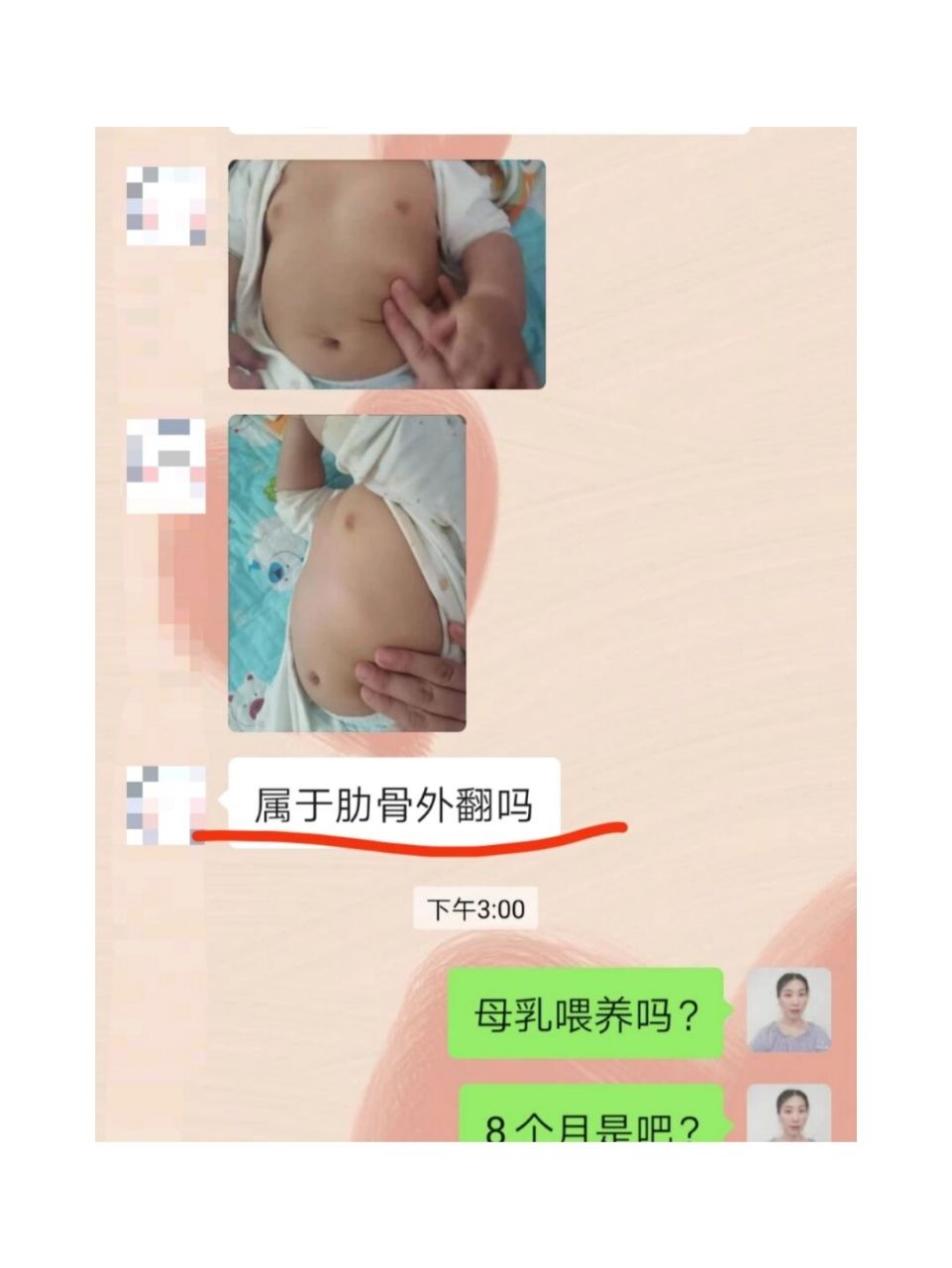 【咨询回复】肋骨外翻? 婴儿的膈肌比较平直,几乎没有弧度.