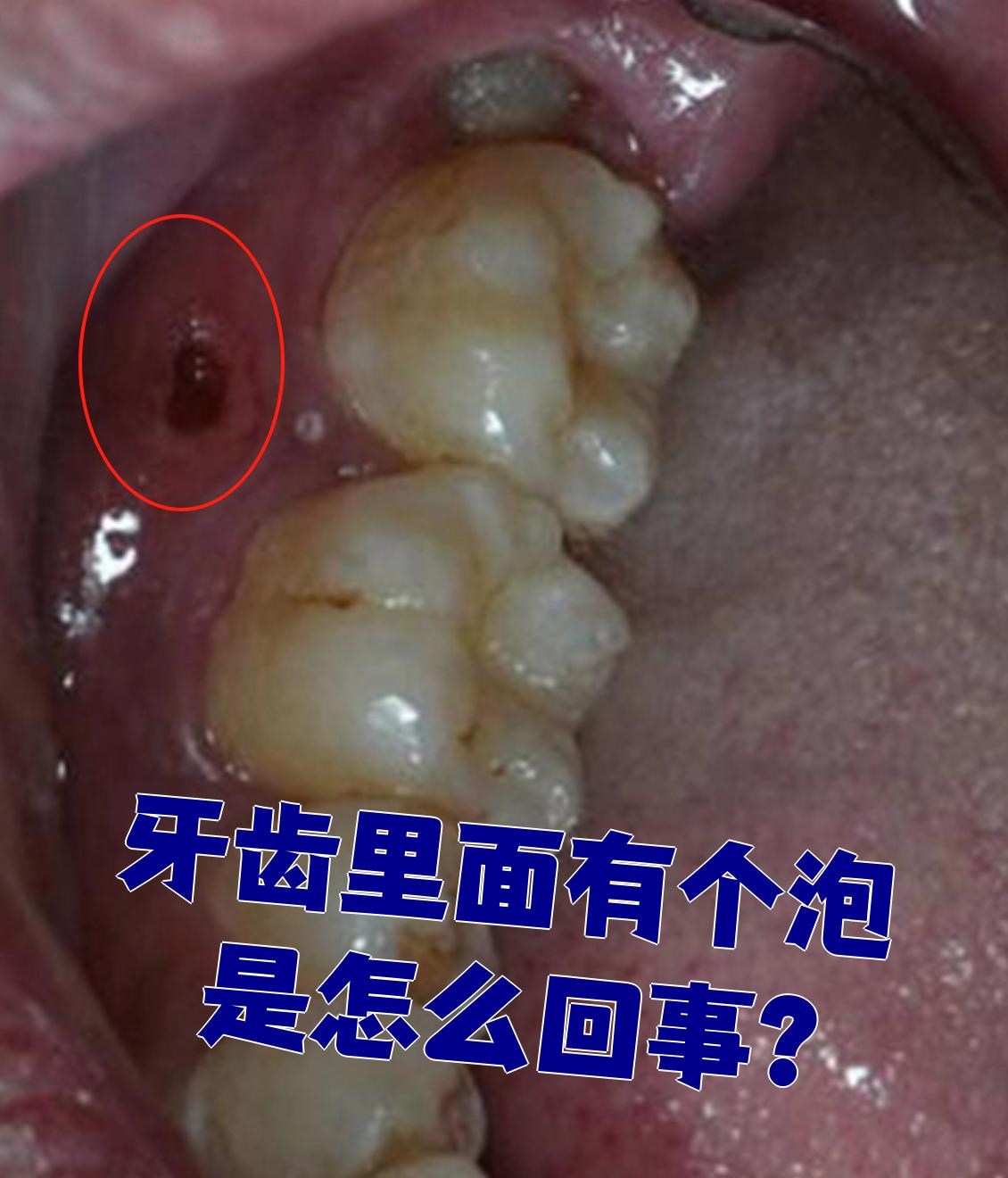 这种情况最常见的原因是牙龈瘘管和根尖周炎