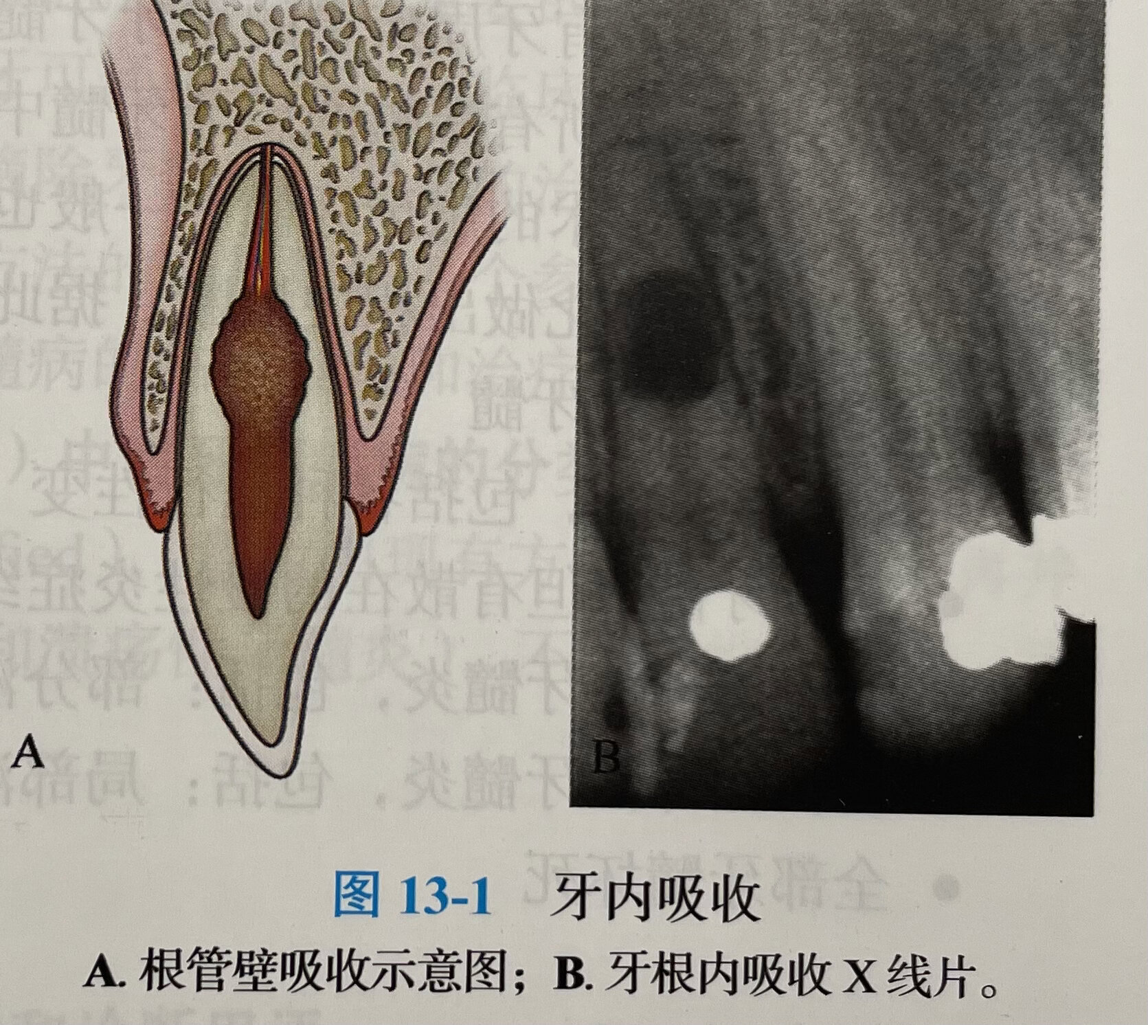 牙内吸收
