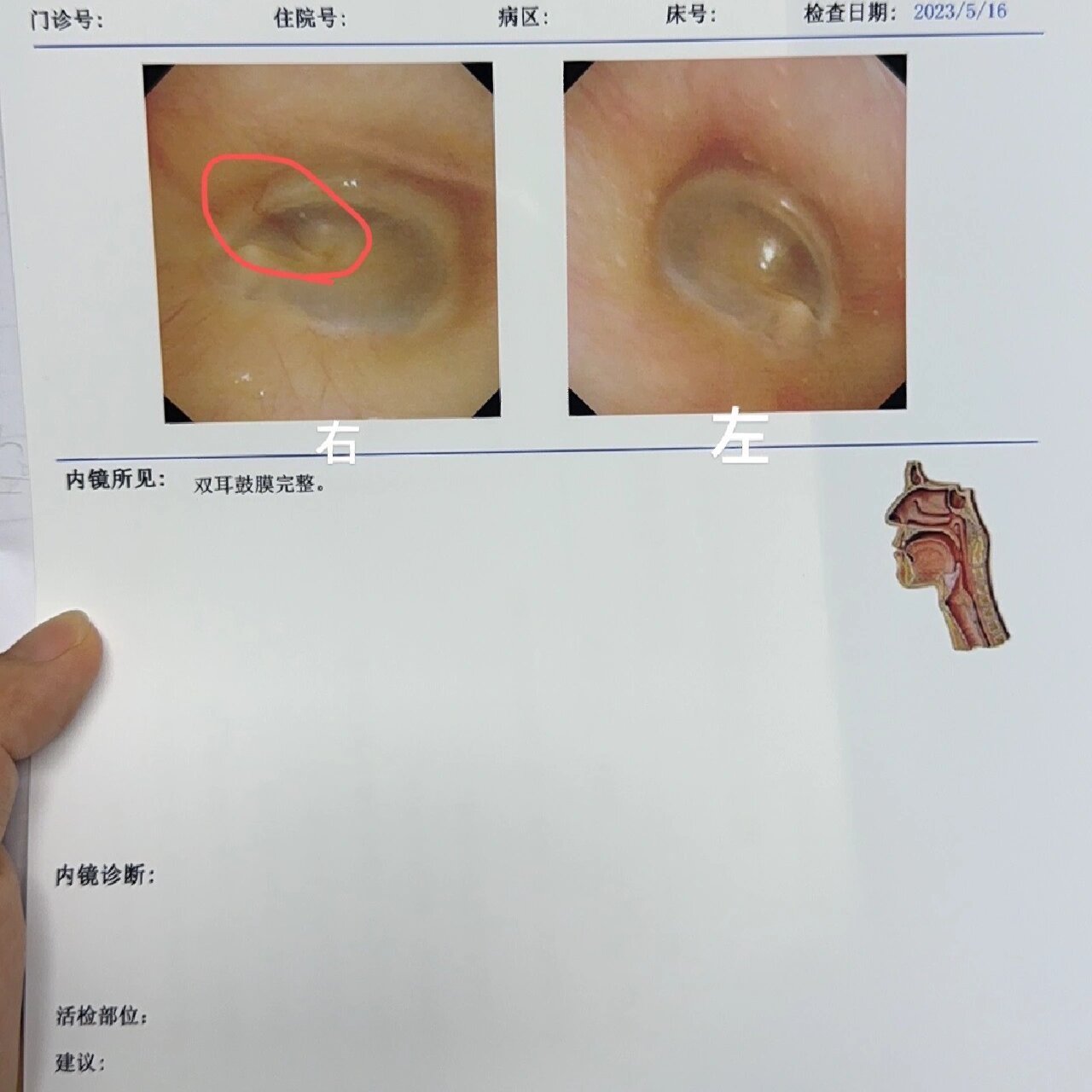 鼓膜充血图片图片