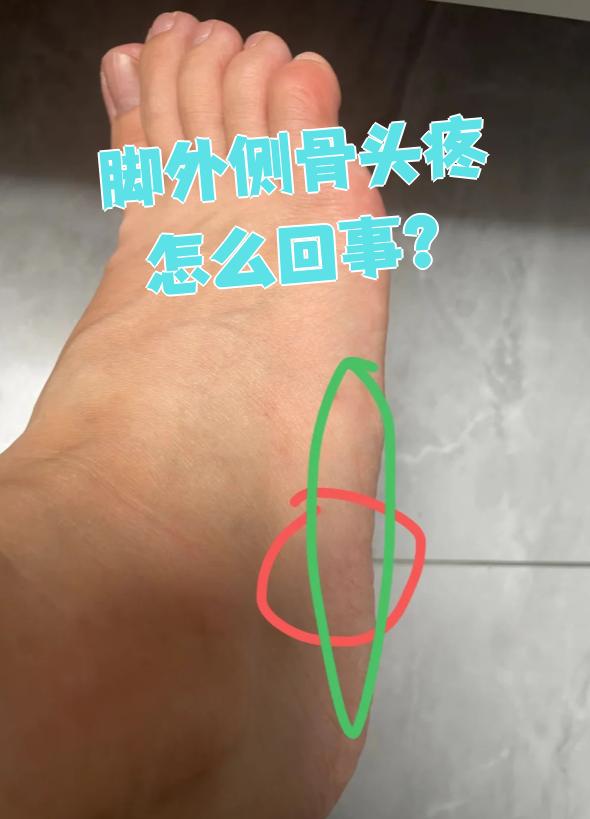脚外侧骨头疼最常见的原因有三个:踝关节炎,外踝骨折和痛风
