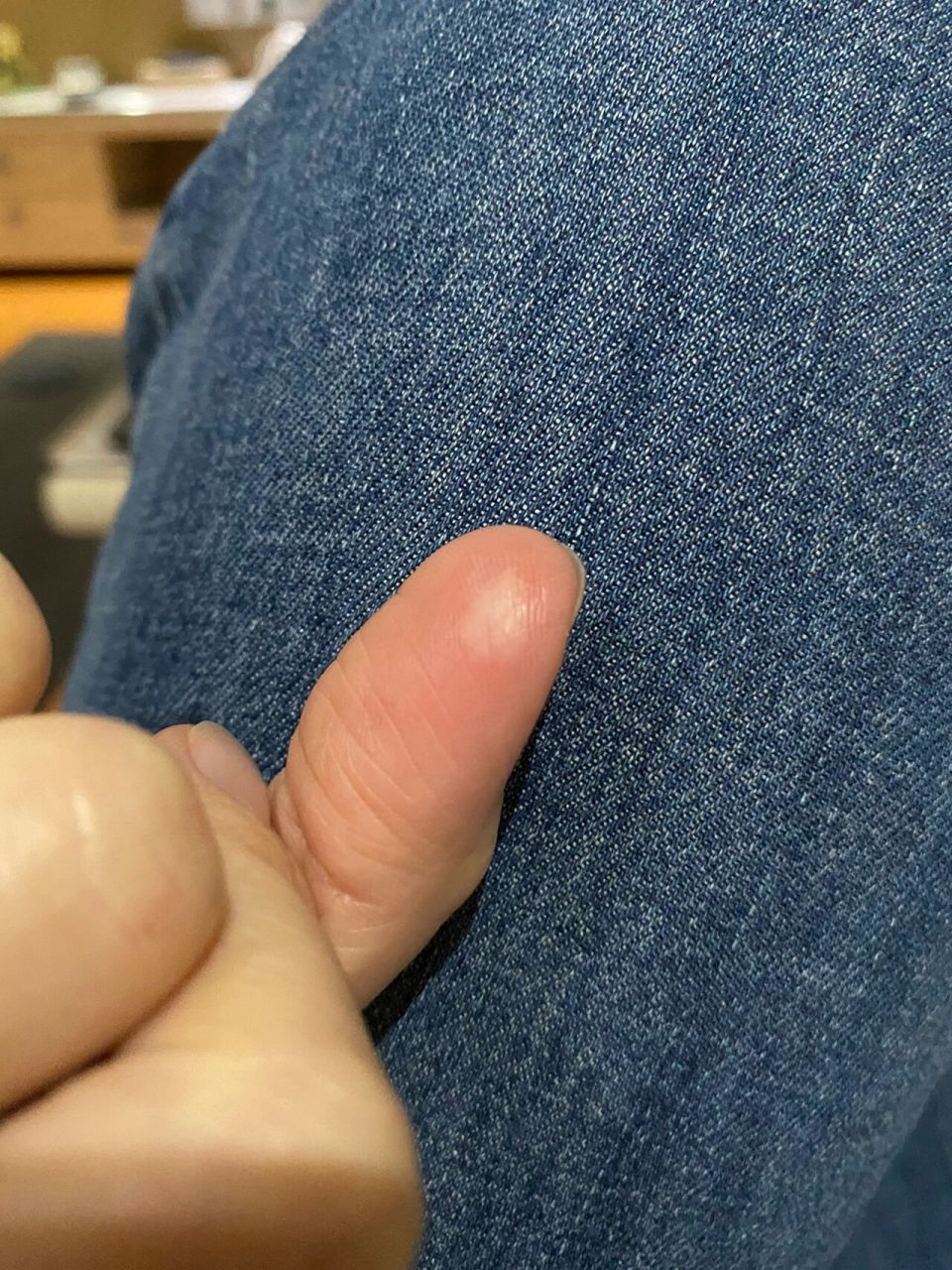 手指被烫起泡怎么办?