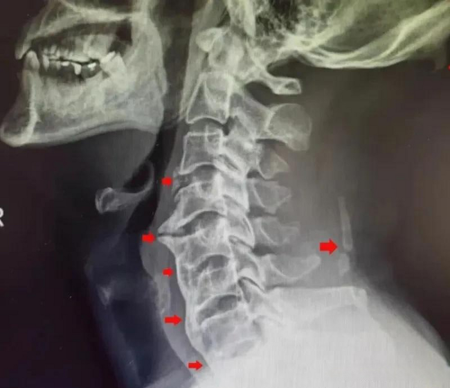 椎侧位x线片颈椎生理前凸曲度尚可,从c34椎间隙开始向下,所有的前纵