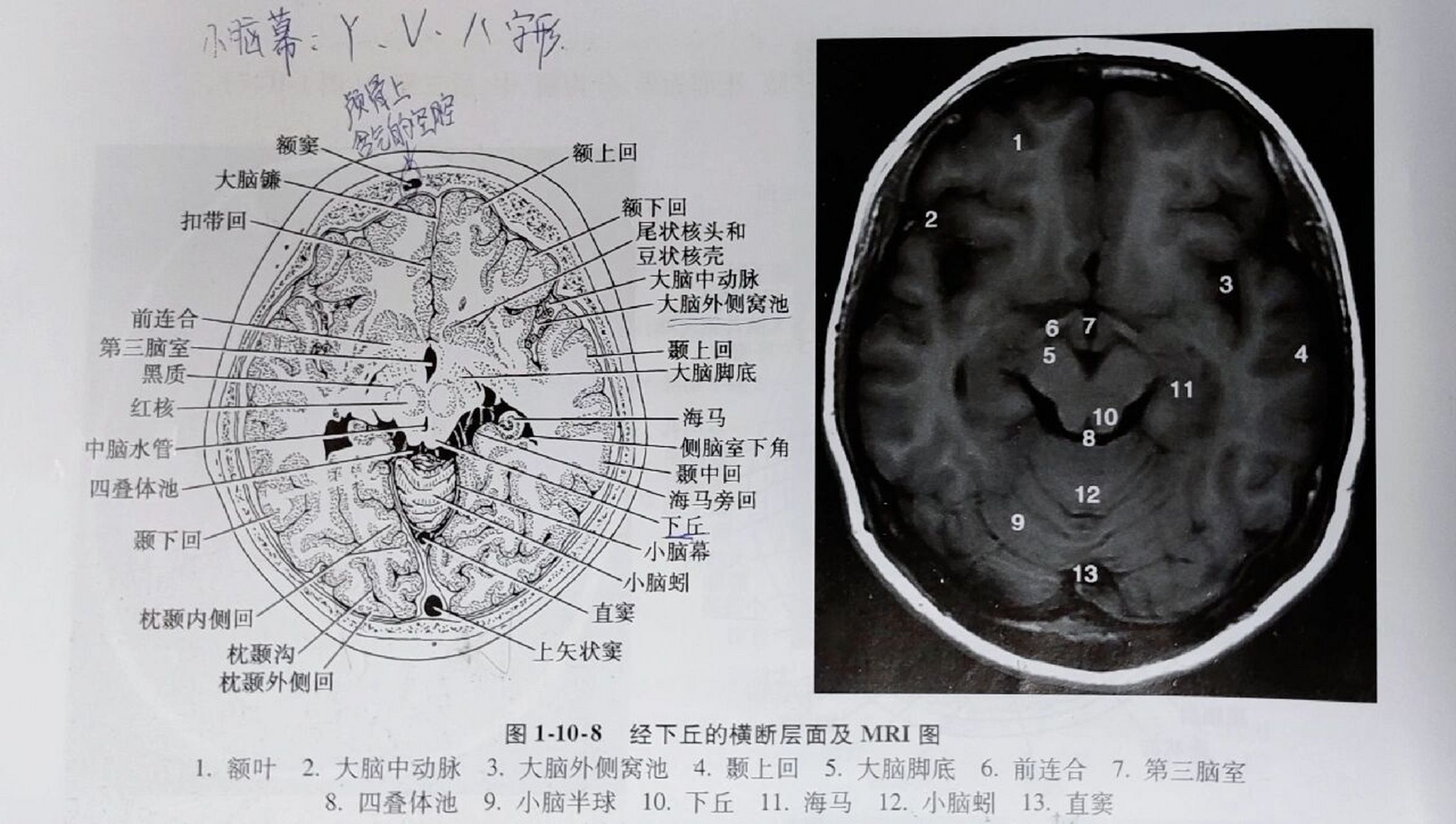 《头部的断面解剖及影像①》 1.经中央旁小叶上份的横断层面 2.