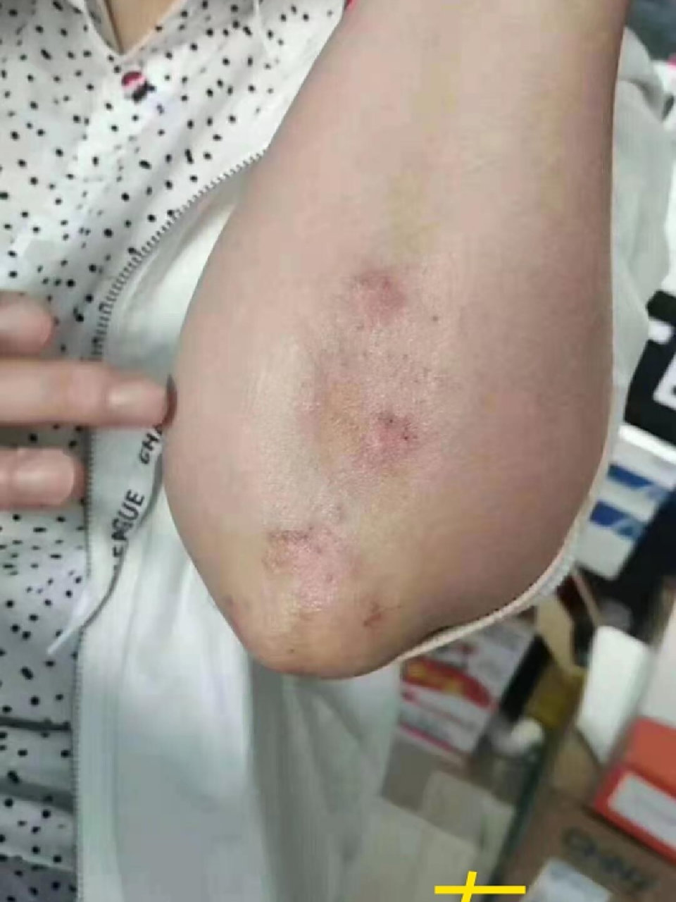 929292肘癣好啦9696