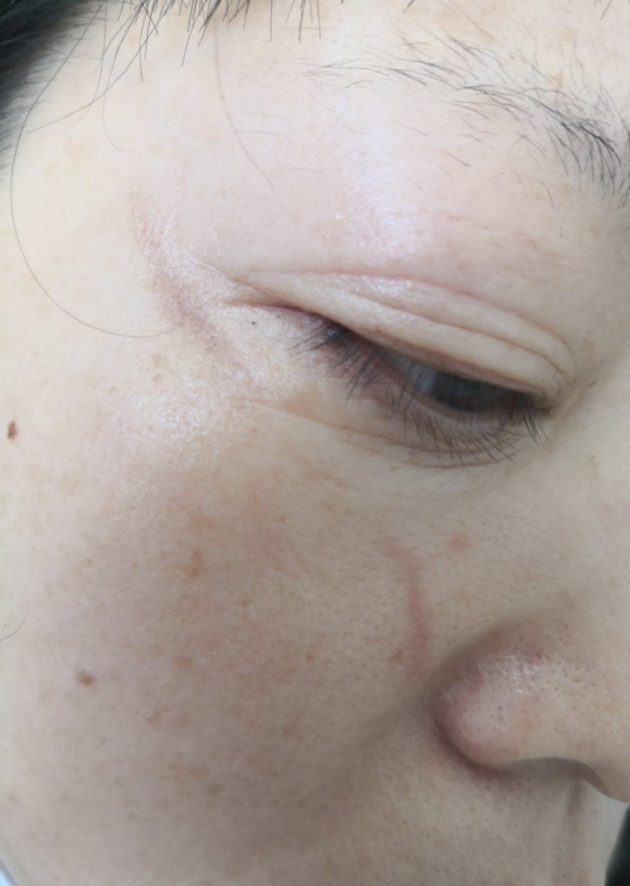 面部外伤后疤痕和色素沉着过度症状.#美容##色素沉着