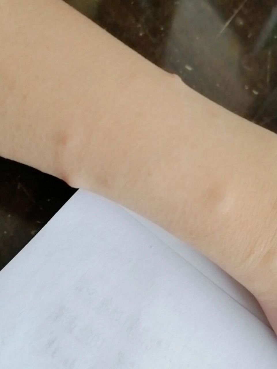 罕见病,神经纤维瘤 从小胎记多,不敢穿吊带,成年以后出现了小肉瘤,去