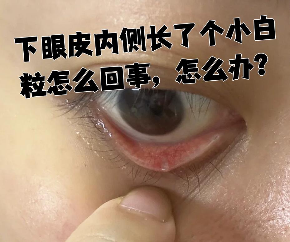 如果是结膜结石,这是结膜受细菌感染刺激形成的白色颗粒