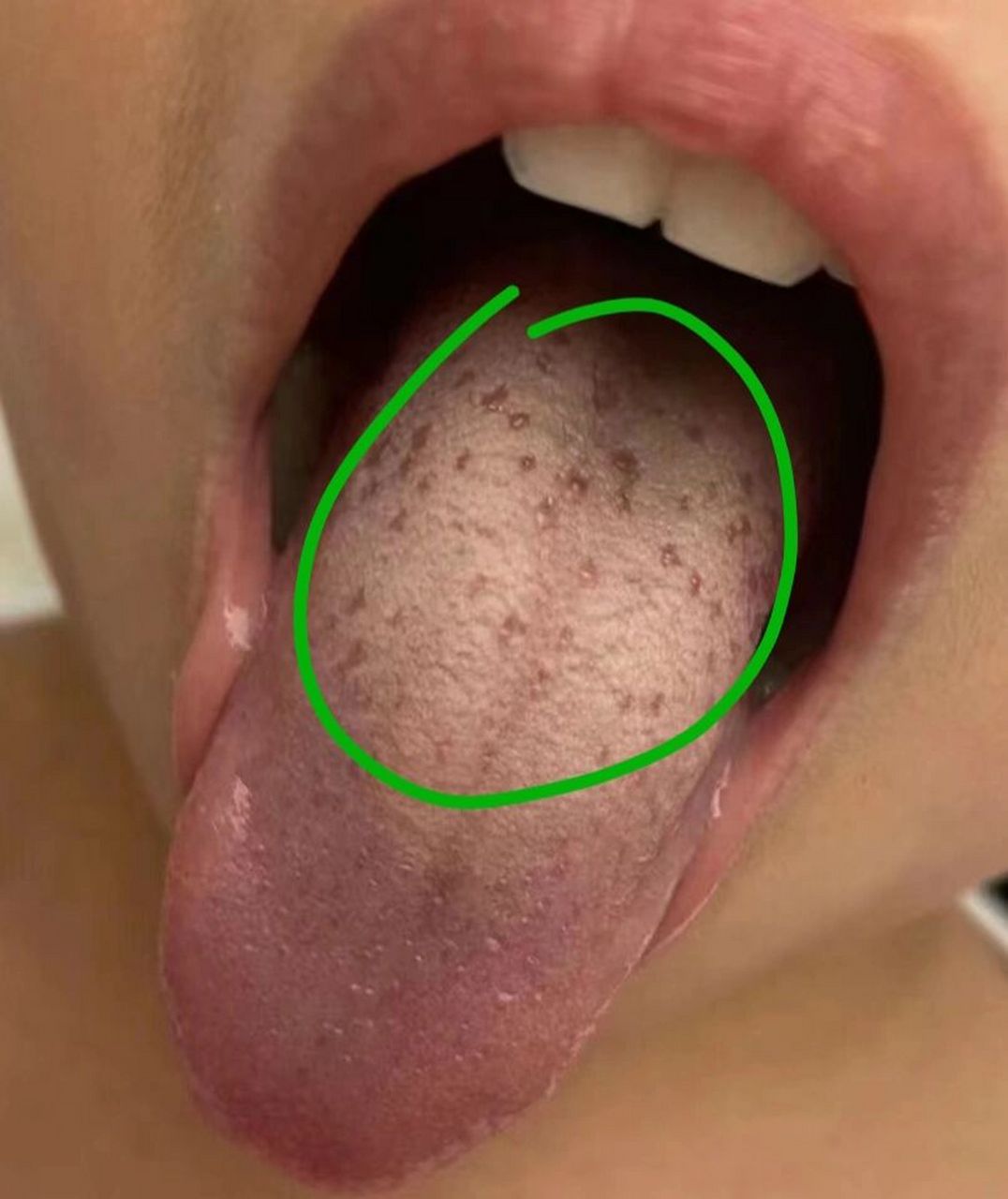 积食伴痰湿,舌中高凸,脾虚腹胀 舌面布满了很多气滞点,气机不通 舌头