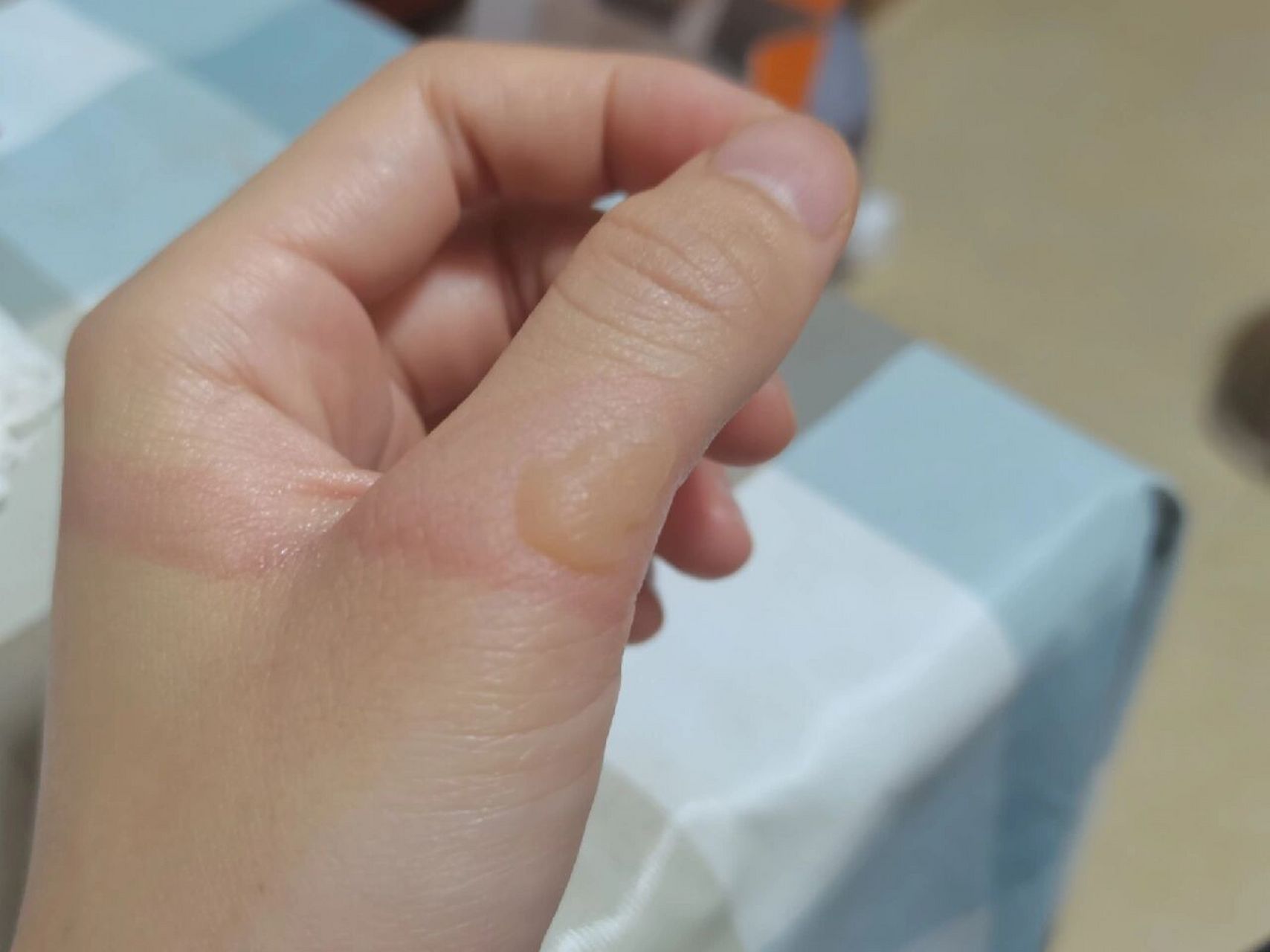 擦了烫伤药膏,原本没起泡,去洗了澡,可能水有温度碰到了,突然起水泡