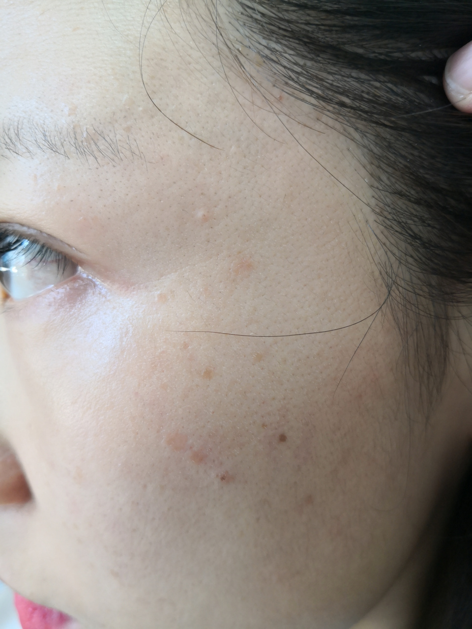 面部扁平丘疹,皮色或者褐色斑块.