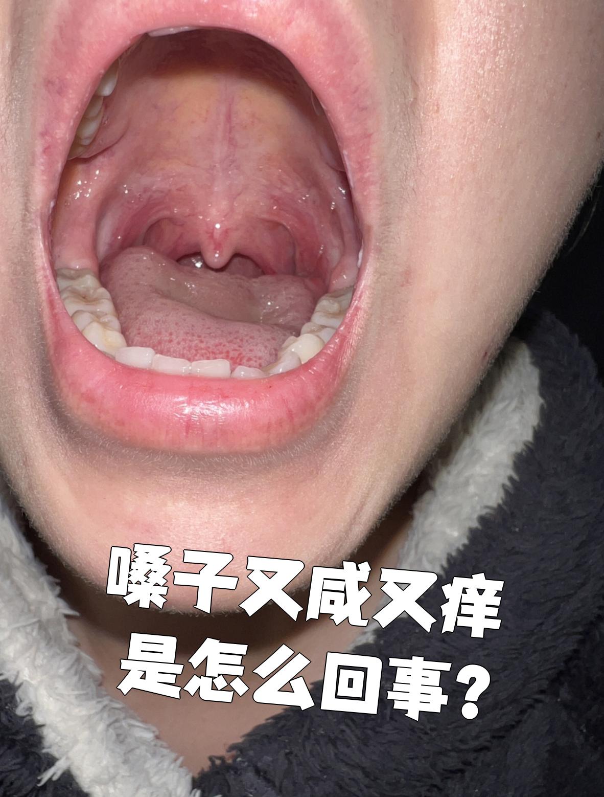 急性咽炎,急性会厌炎,急性扁桃体炎或反流性咽喉炎等原因引起的,需要