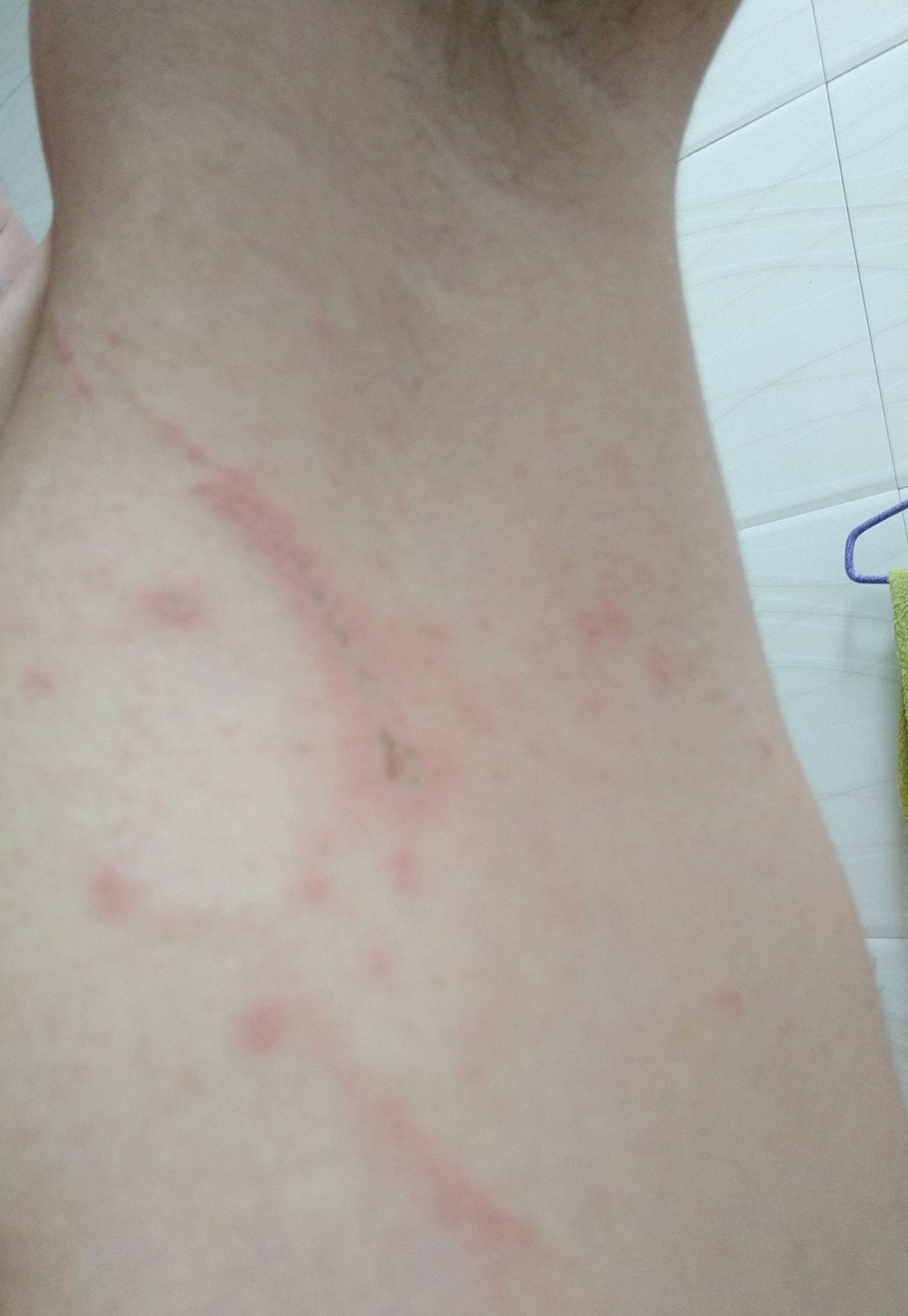 腋下长了些东西不知道是什么红红的还有些小泡泡白色的然后还有疤痕