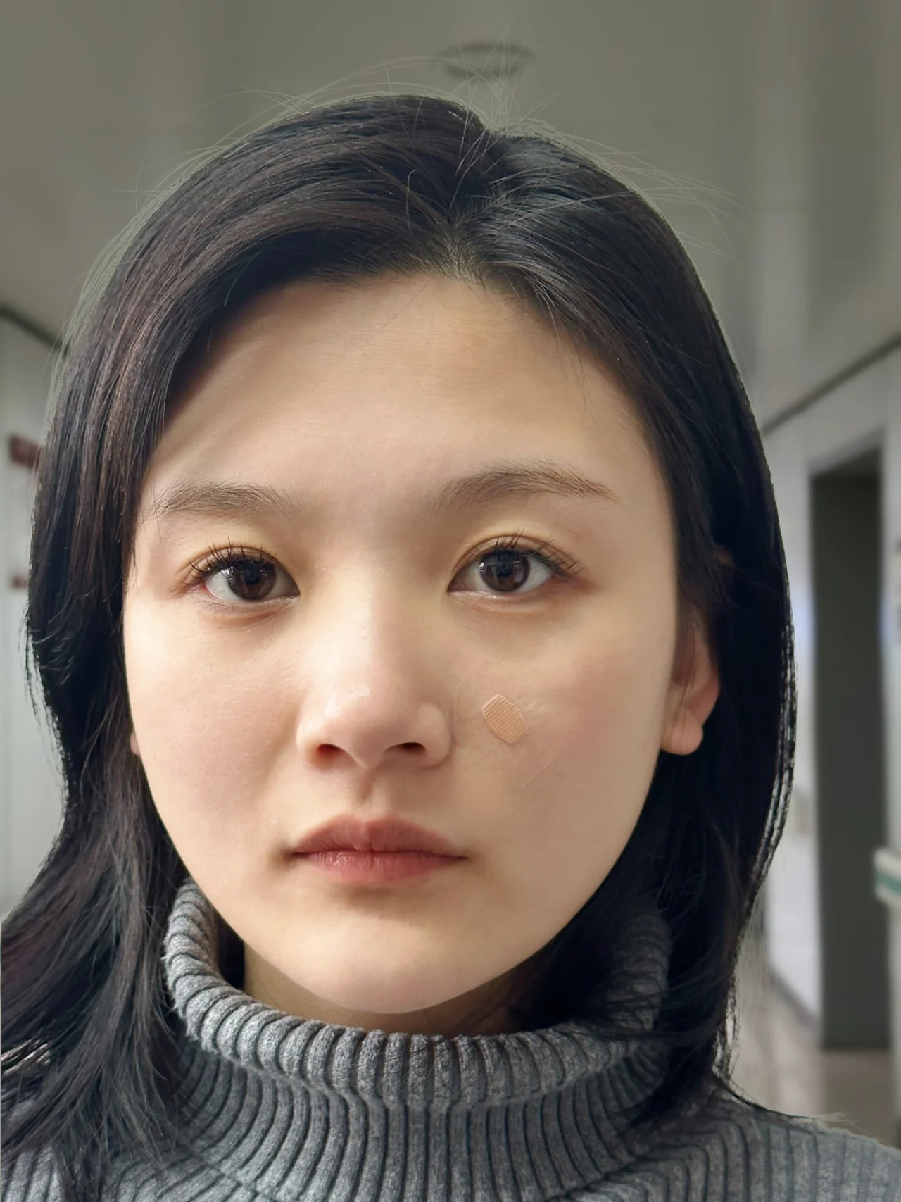 激光点痣75天,我真快成半个行家了