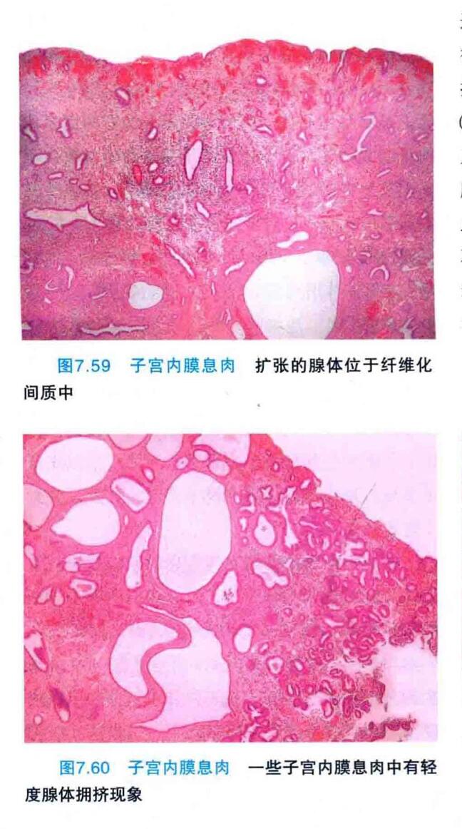 子宫内膜息肉标本图片