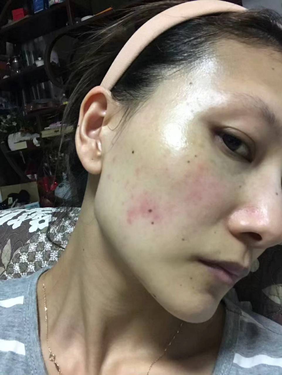 玫瑰痤疮,最严重的爆发期 图一为第一次正规治疗前,2018年七月.