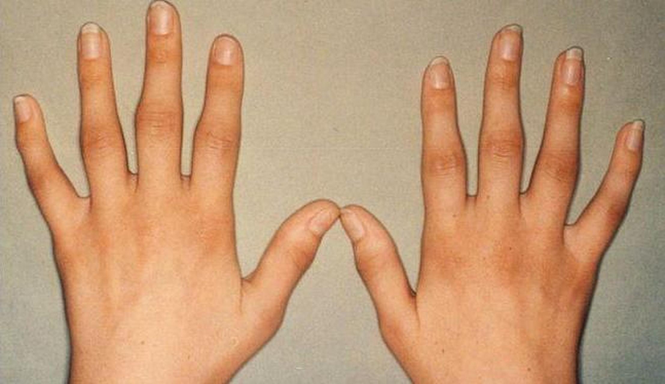 类风湿患者:吃中药好了90%以上!