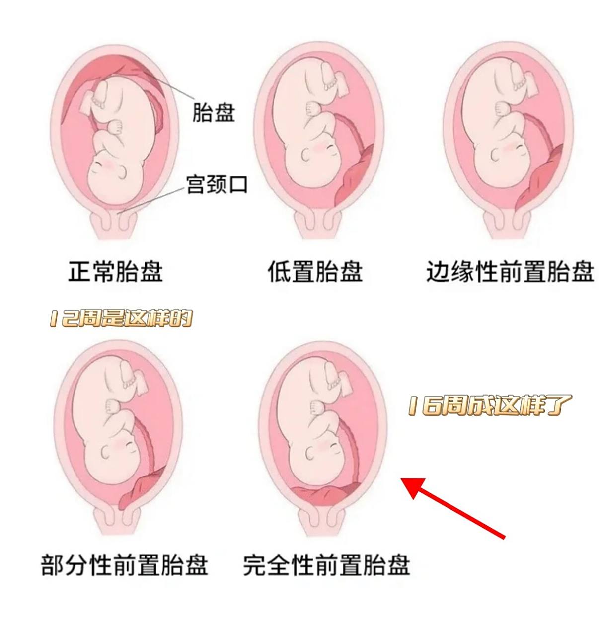 16周得知完全性前置胎盘 得知自己完全性前置胎盘,医生告知我,是真的