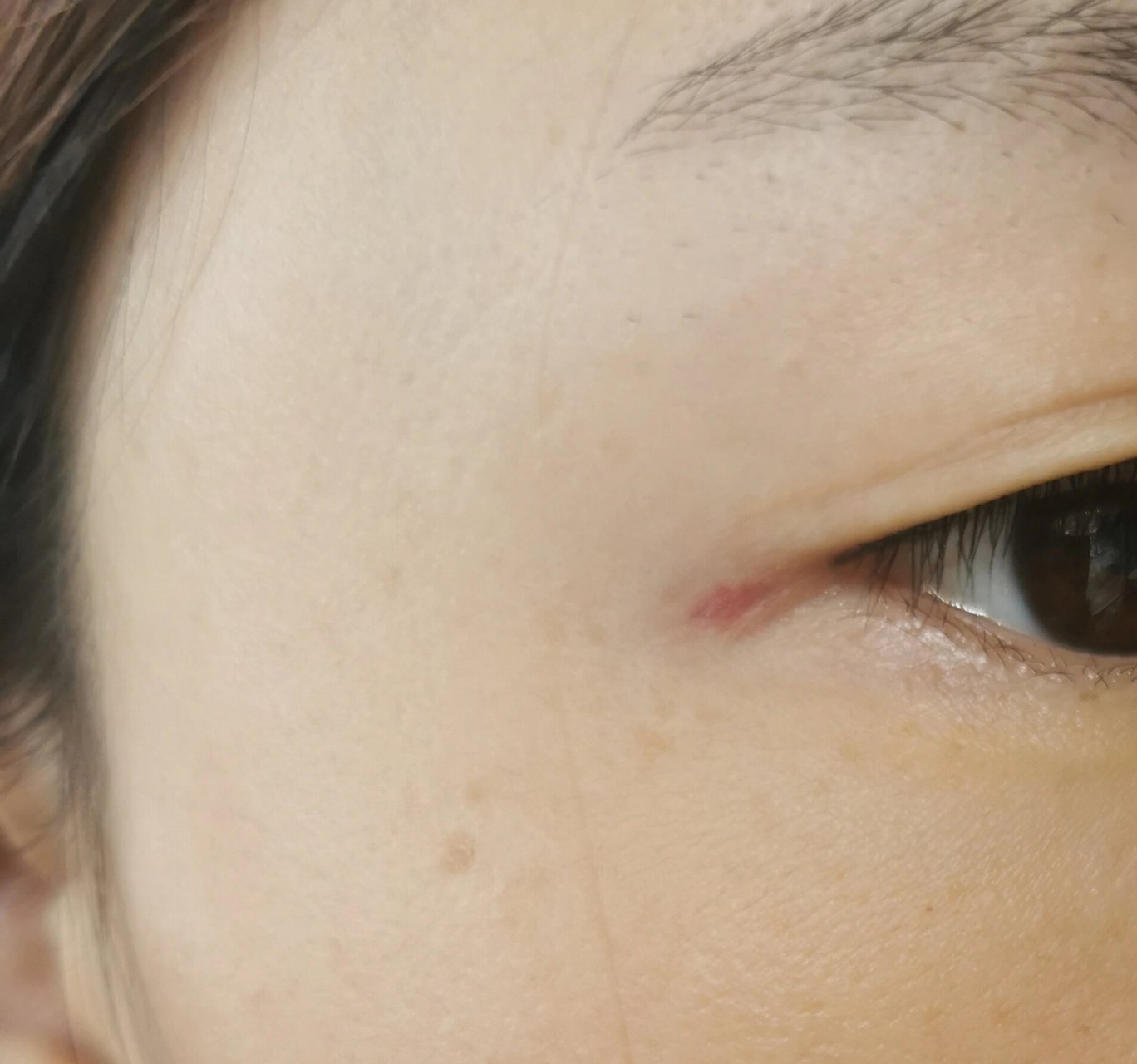 眼角皮肤突然红了一块 不疼不痒,突然照镜子就发现了,这是什么呀?