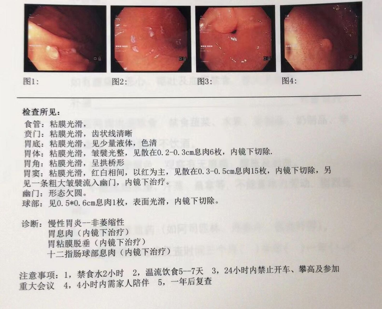 胃息肉术后恢复 上篇写了一点做胃息肉手术的内容,很多姐妹都在询问术