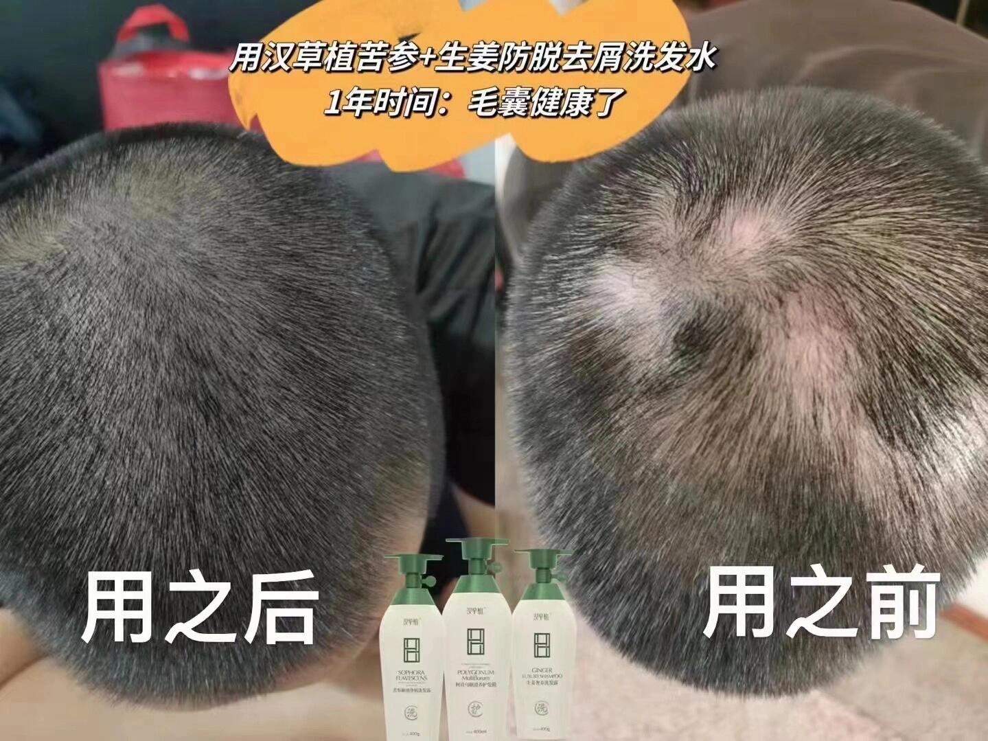 头发突然秃了一块怎么回事