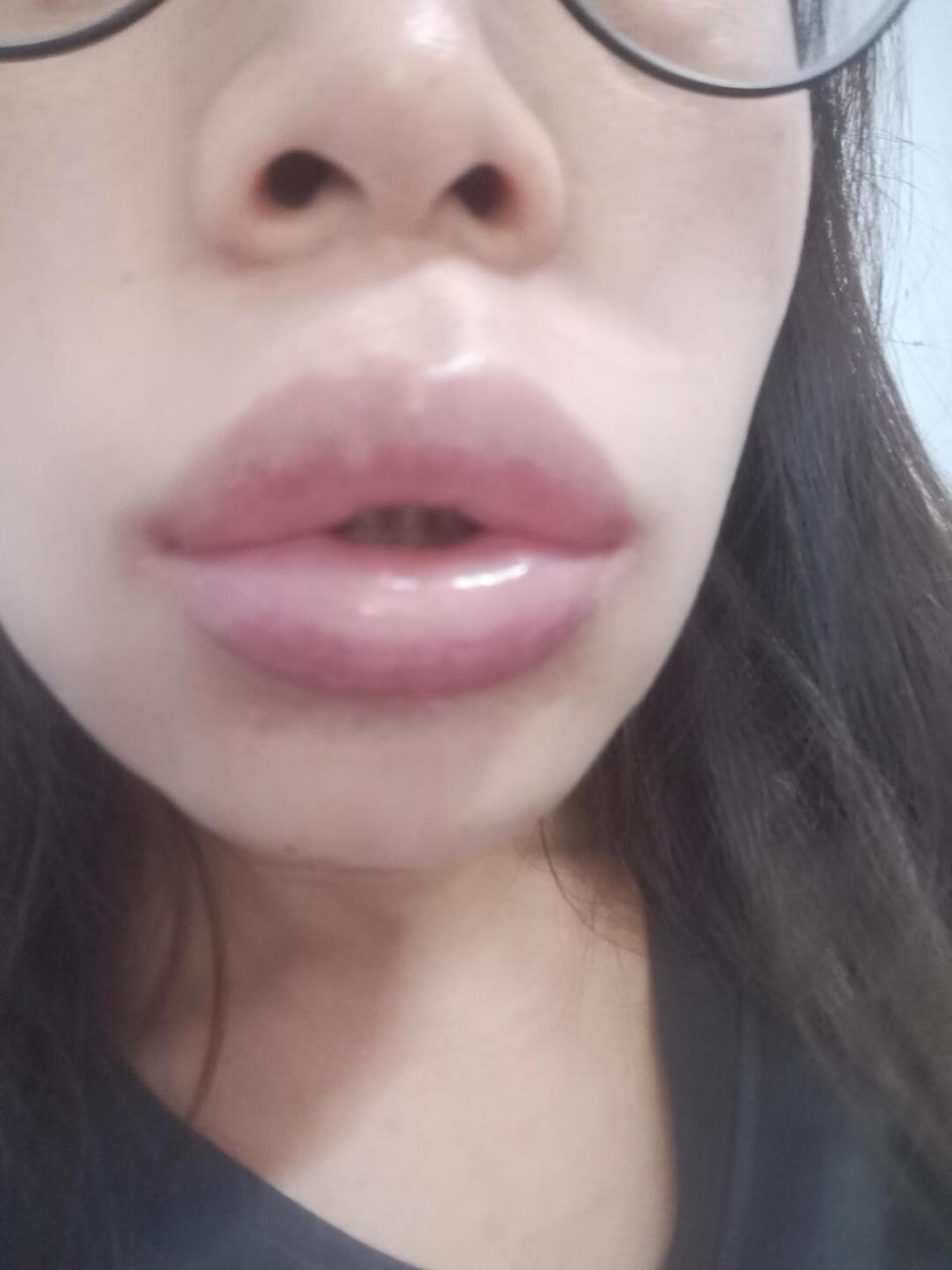 皮试做了没事儿,平常也吃头孢,但是今天输头孢过敏了,浑身长包,脸肿