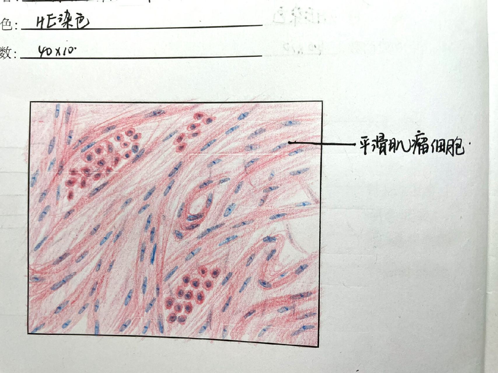 病理学手绘切片分享～ p2:子宫平滑肌瘤 p3:平滑肌肉瘤 16615子宫