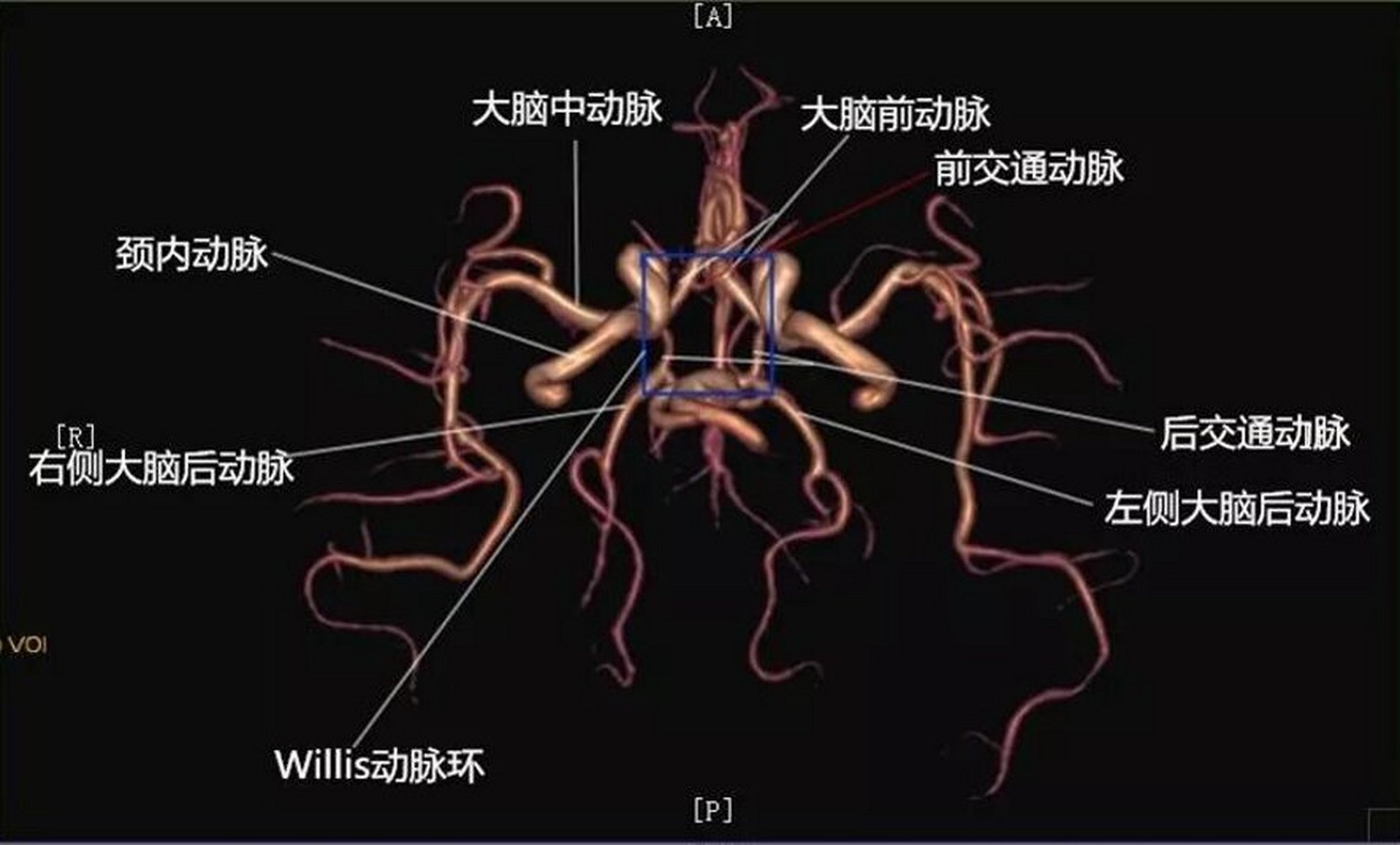 大脑动脉解剖图影像学图片