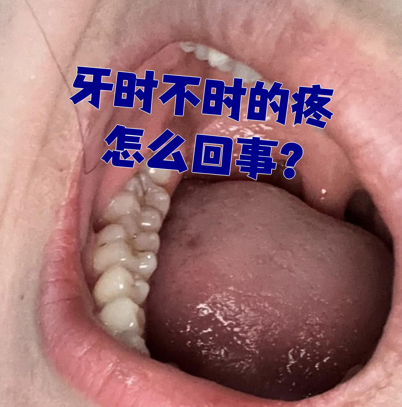 牙齿时不时疼最常见的原因是深龋