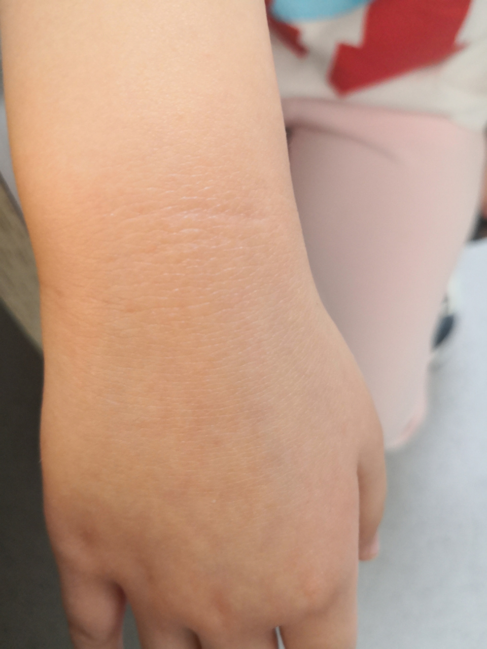 考虑摩擦性苔藓样疹/沙土皮炎.#过敏