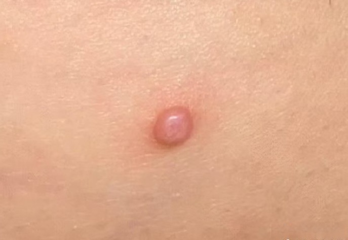 健康护肤月##微博兴趣创作计划#皮小徐的私人定制超话 照片上的丘疹