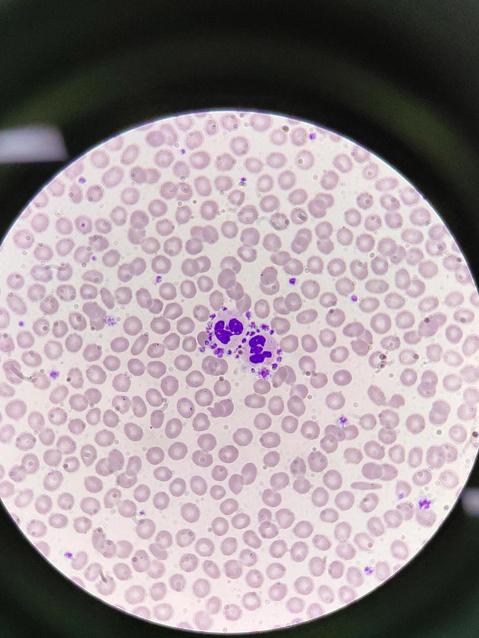 血小板卫星现象959595 97血小板卫星现象:血小板黏附,围绕于