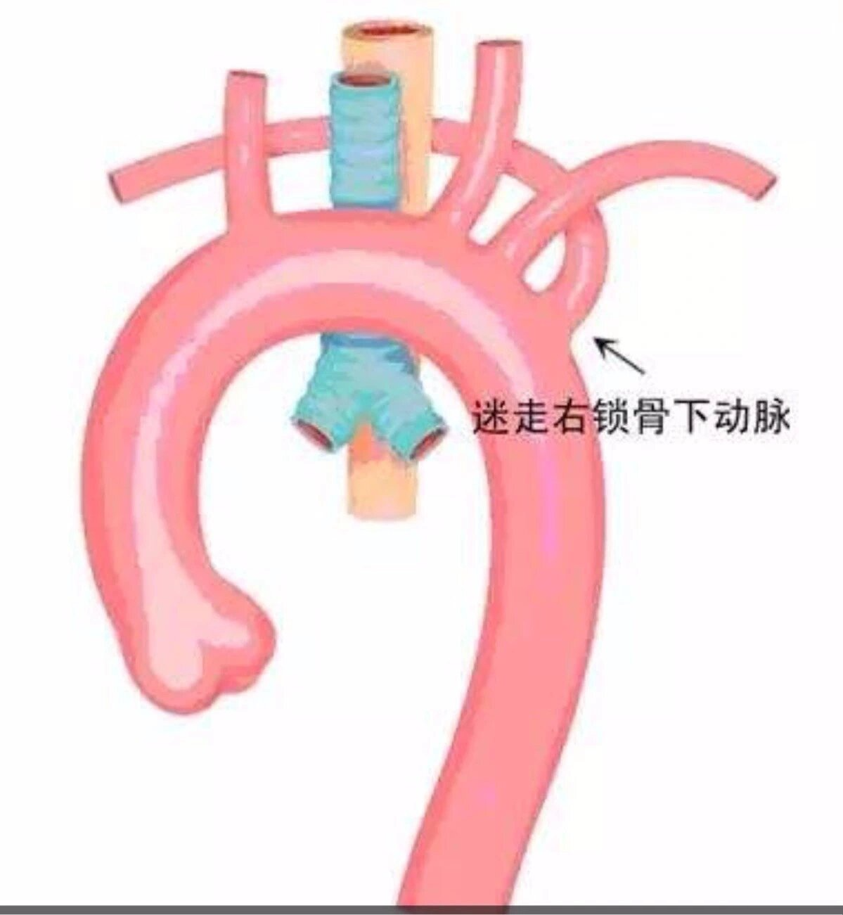 锁骨下动脉位置图图片