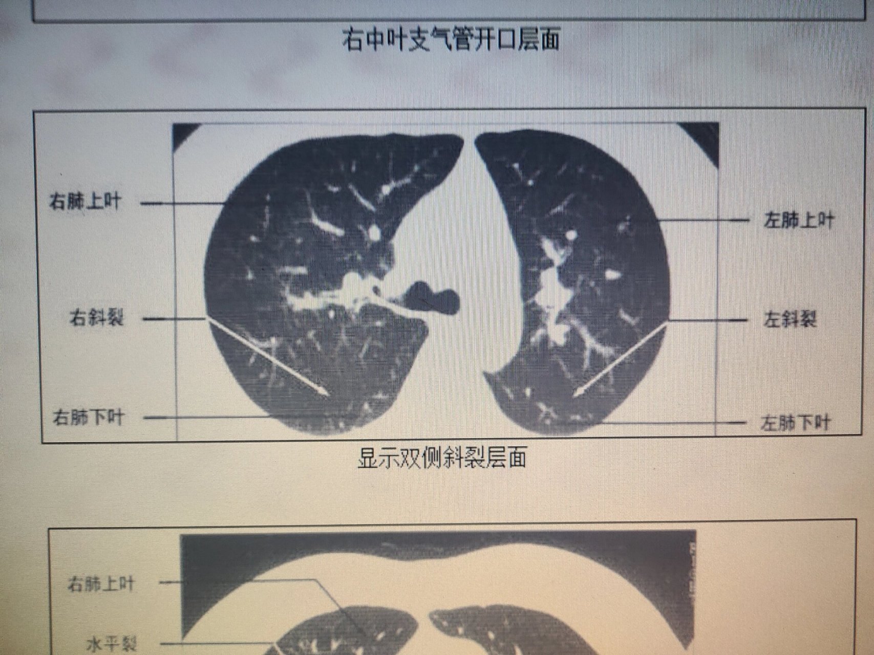 肺部正常ct图片图片