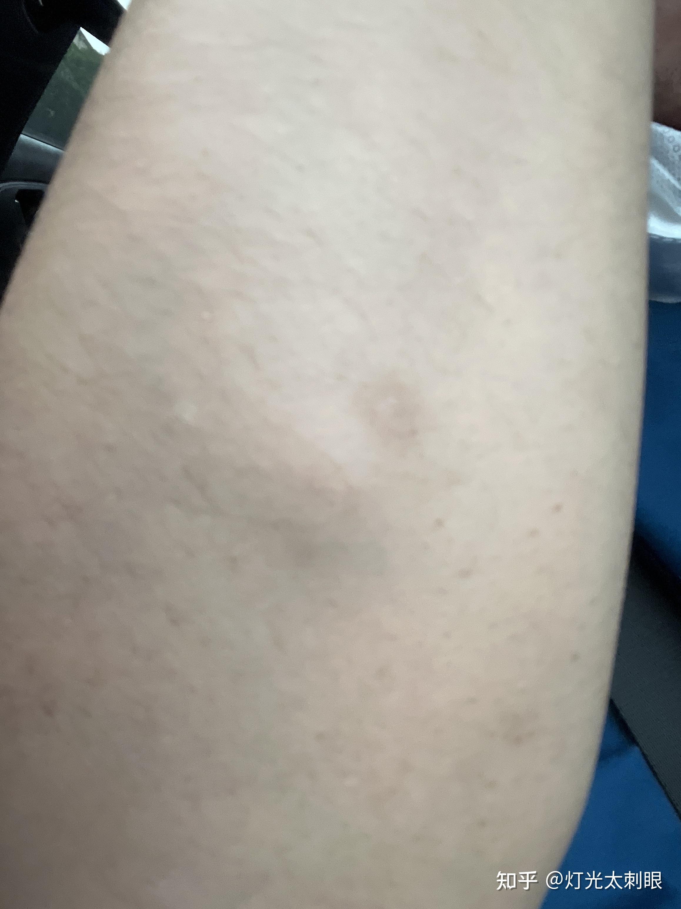 手臂上长了几个硬包肿起来怎么回事