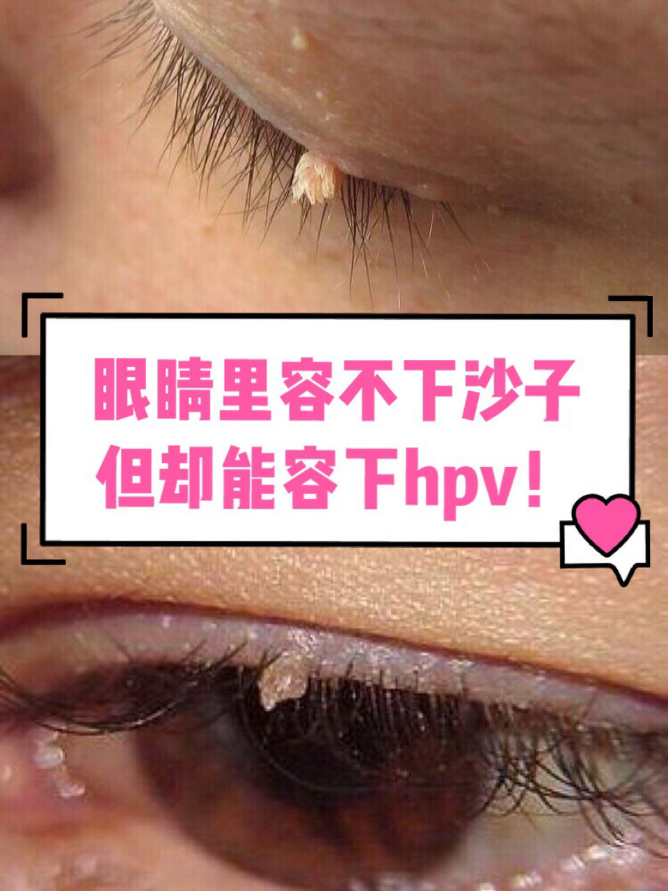 眼周这种小疙瘩要警惕,有可能是hpv阳性感 眼睛也是会感染hpv病毒的