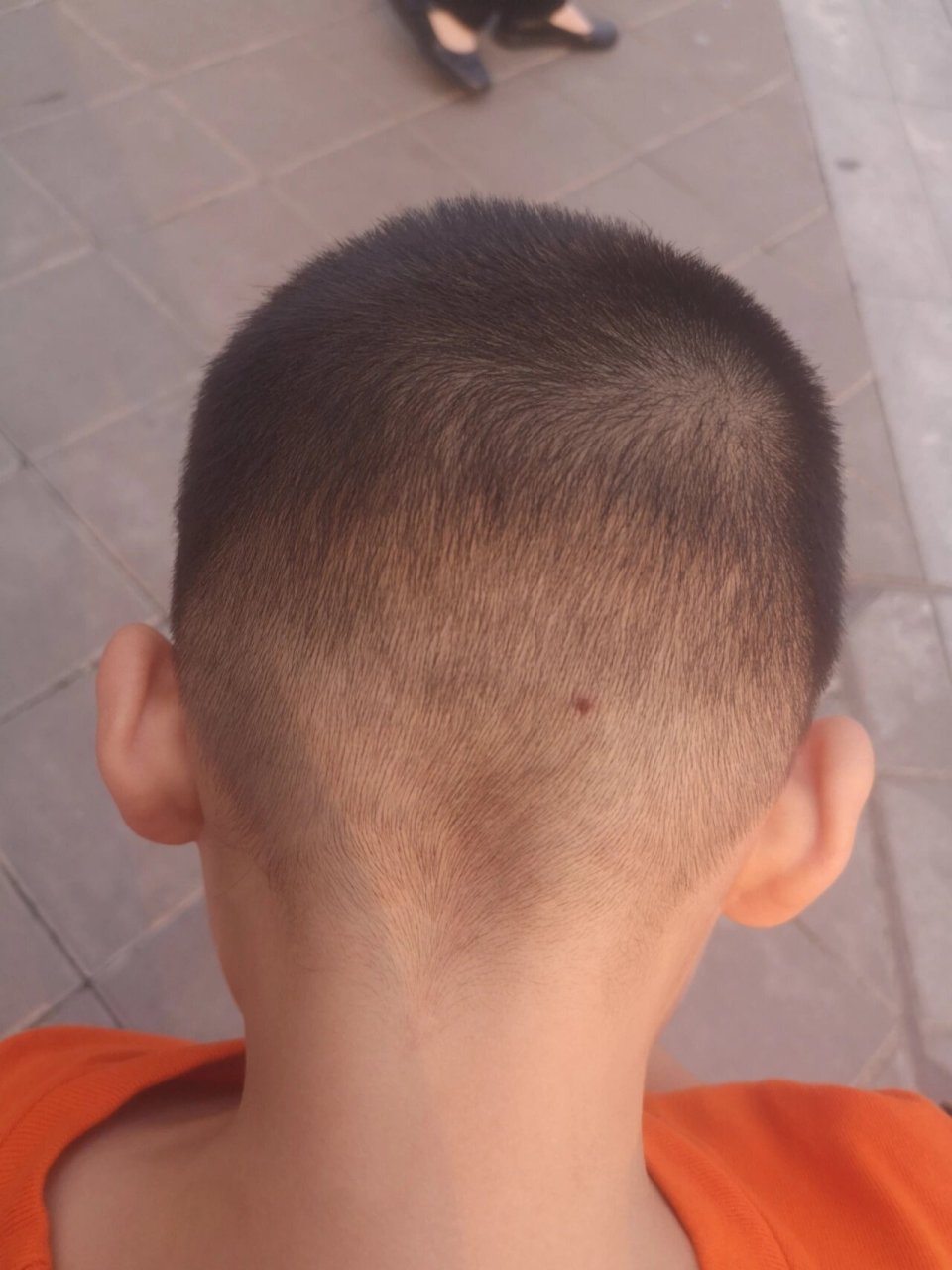5岁男孩发现头皮长了个痣,用不用去医院看 我真是个粗心的妈妈,刚刚