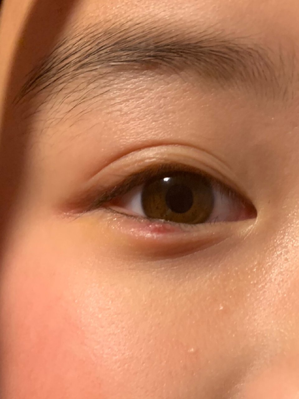 麦粒肿 刚开始是上眼皮先发生麦粒肿,上眼皮用药2天后,下眼皮发生红肿