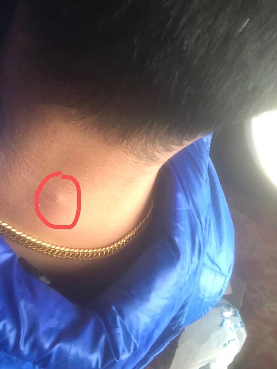 皮脂腺囊肿发炎了 先消炎,看来年后这一刀躲不掉了