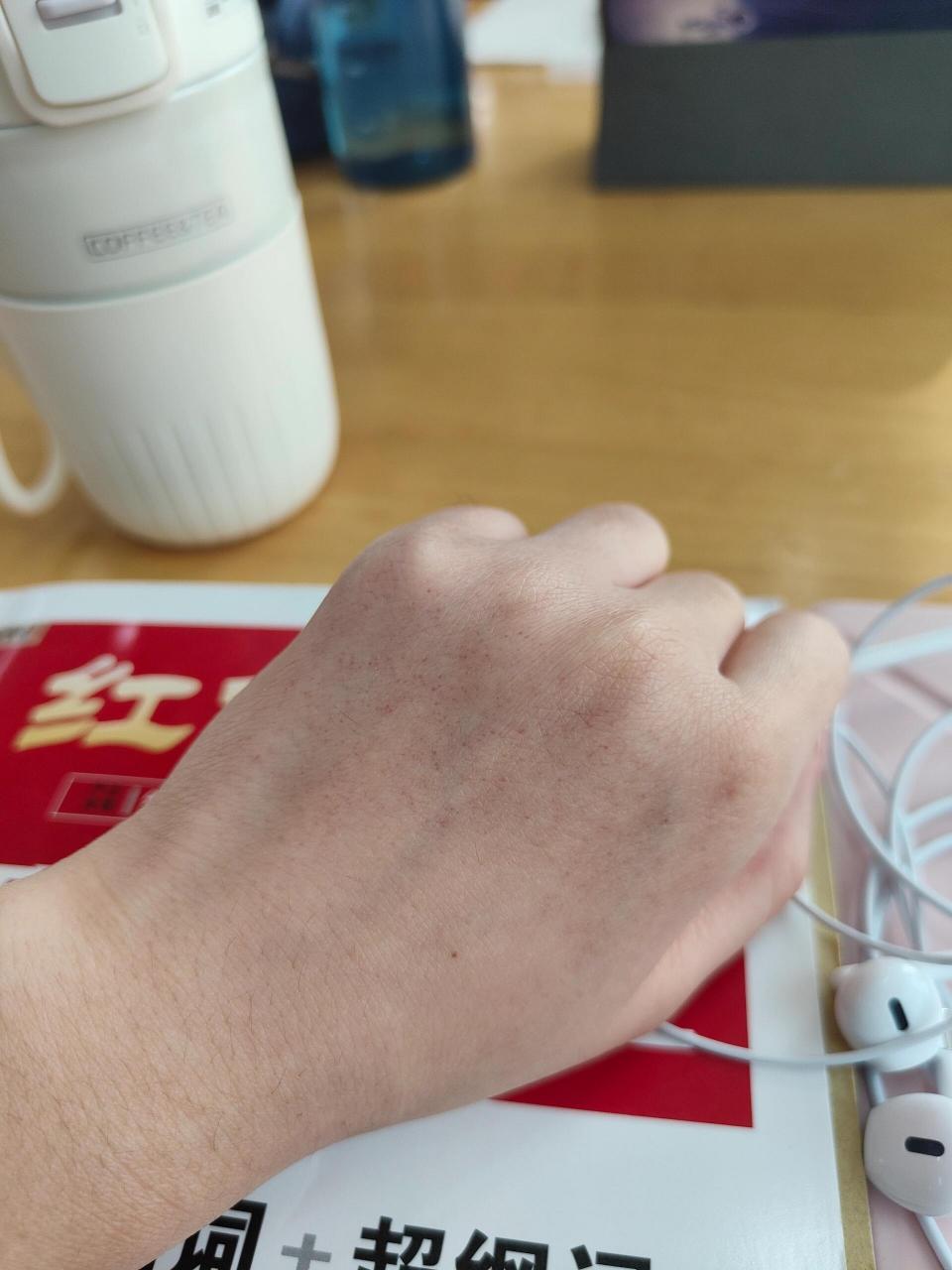 手背上的小红点 早上起来左手手背突然起了很多小红点,不痛不痒,半年