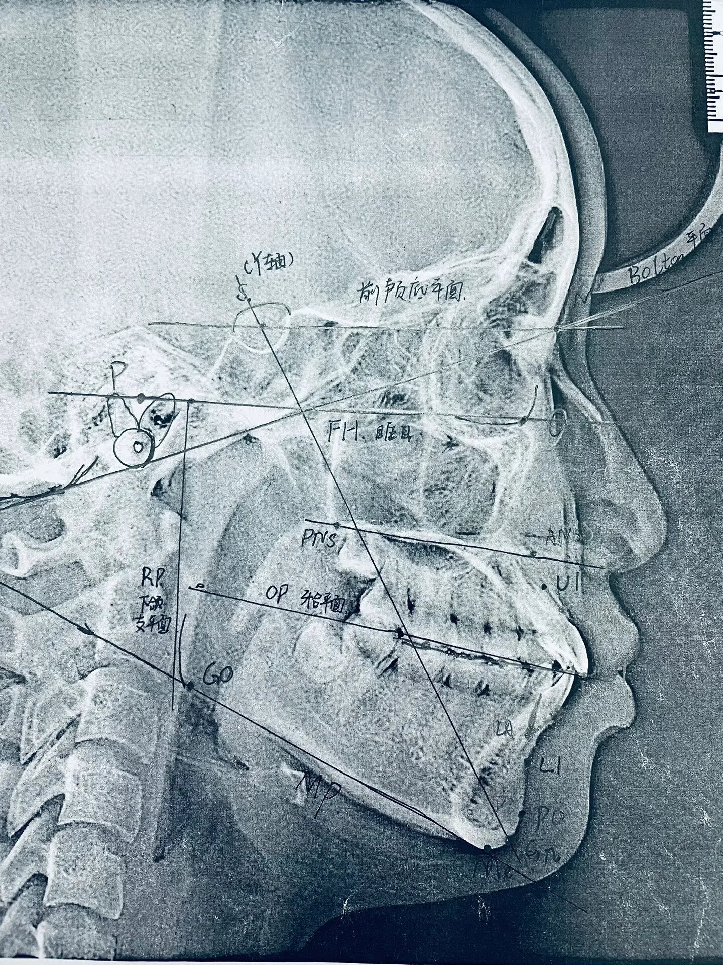 正畸学x线头影测量分析(一) 现找点,后找面,再找角.