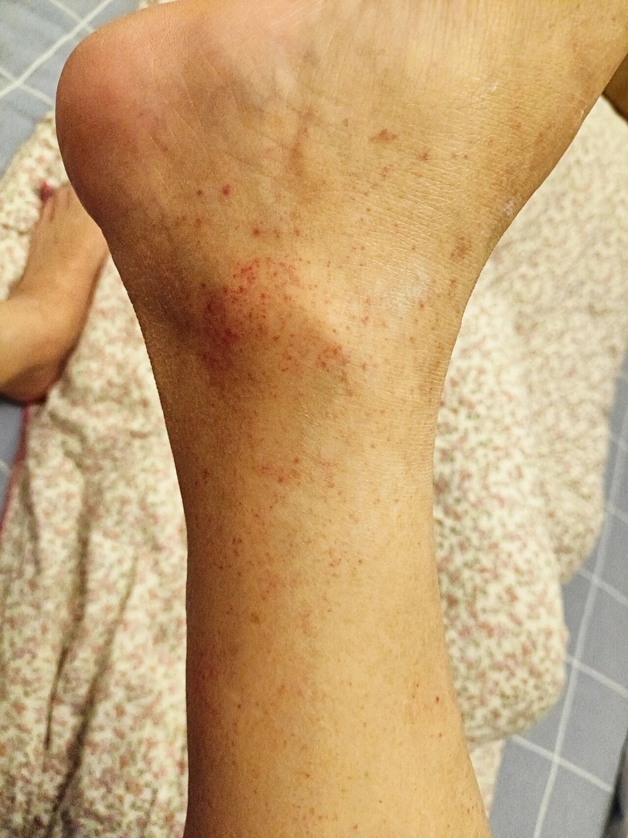 感染新冠后,脚脖出现出血点是怎么回事?