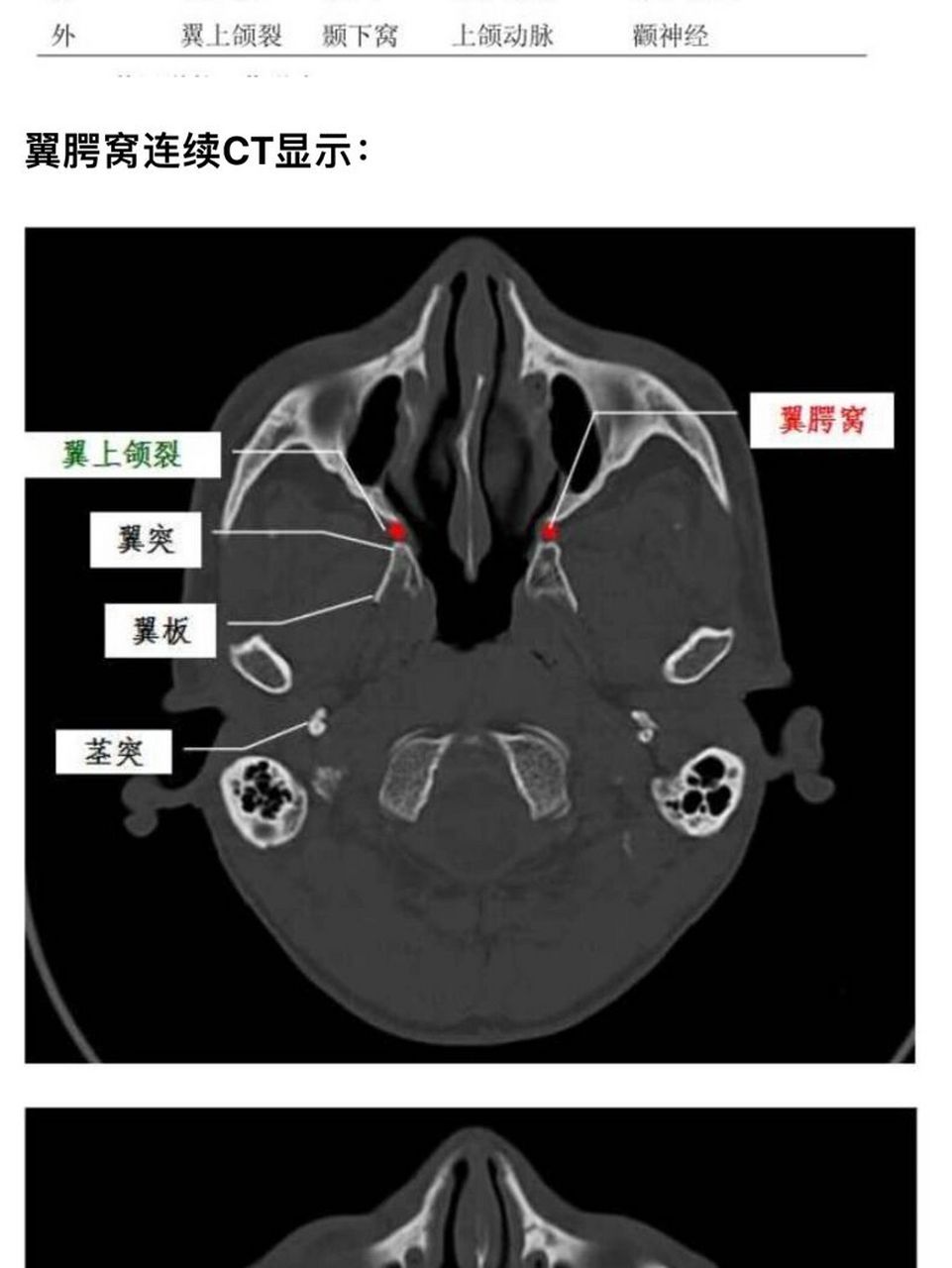 翼下颌皱襞位置图图片